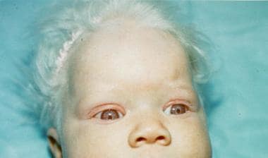 Albinism - الجمعية السعودية لأمراض وجراحة الجلد