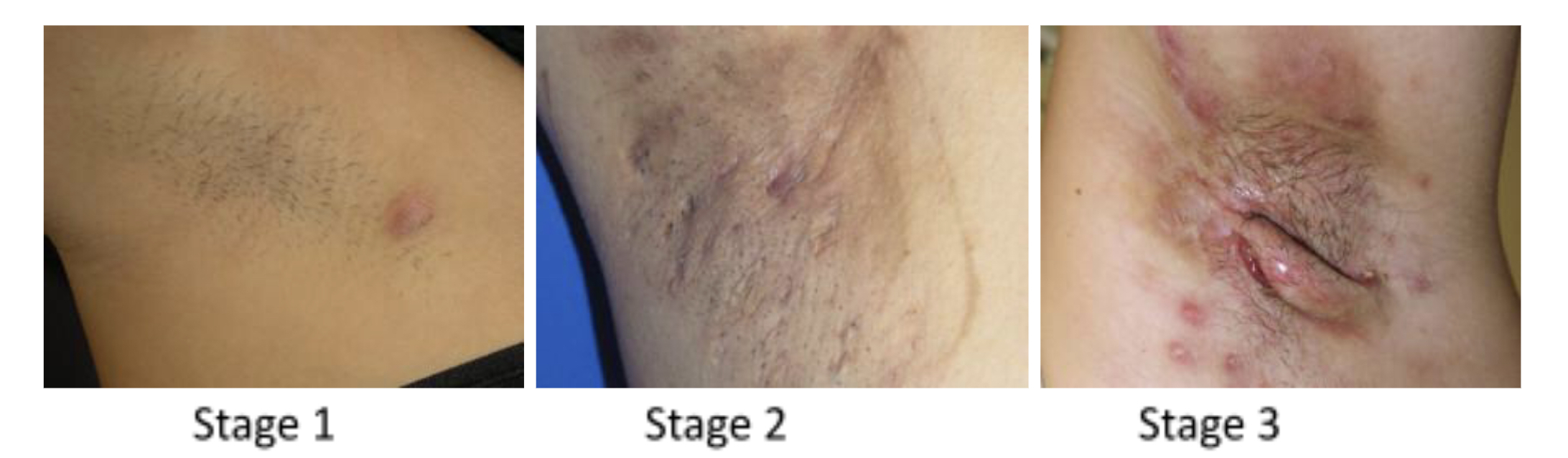 Chronic inflammatory nodules in the groin area